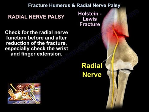 Fracture Humerus & Radial Nerve Palsy - Everything You Need To Know - Dr. Nabil Ebraheim
