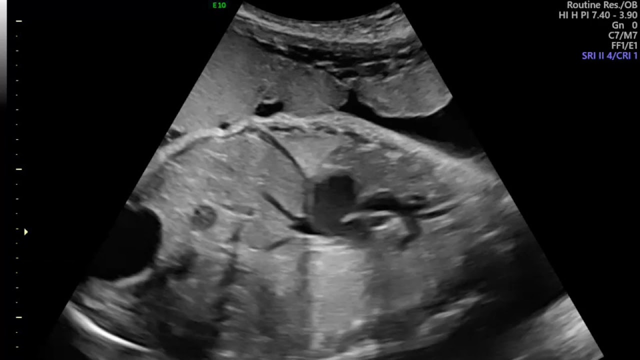 EXAME MORFOLÓGICO FETAL