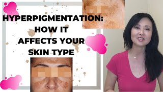 Hyperpigmentation and your Skin Type