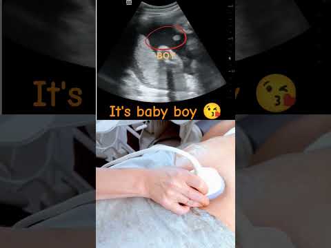Ultrasound showing boy baby !!!🤰