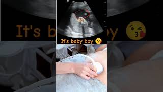 Download lagu Ultrasound showing boy baby !!!🤰 mp3 Download lagu Ultrasound showing boy baby !!!🤰 mp3