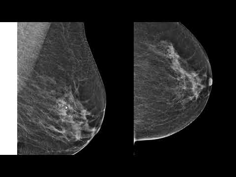 Morfologia e marcação das lesões cutâneas na mamografia