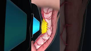 Shockwave Therapy (3D Animation)#shockwave #shockwavetherapy #therapy #muscul #musculosketal