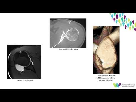 OrthoFracs - Posterior Shoulder Instability by Dr. Phoebe Walker