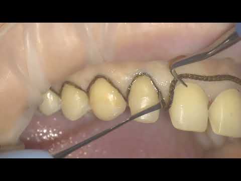 Ретракция непрерывной нитью верхнего зубного ряда