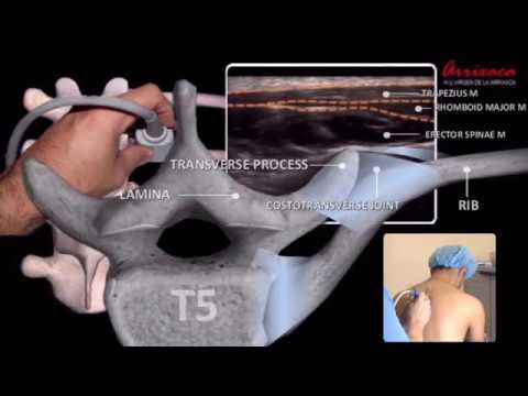 The ESP (erector spinae plane) Block - Our Current Understanding