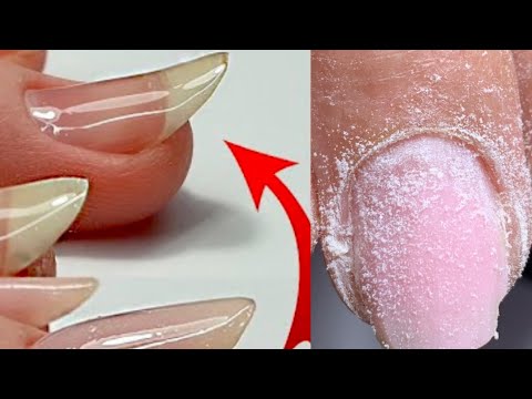 Nail TORN OFF Nail Bed 😨 Correcting Nails