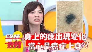 身上的「痣」出現變化，當心是癌症上身？！【#醫師好辣】20220407 part4 EP1310 陳榮堅 張振榕