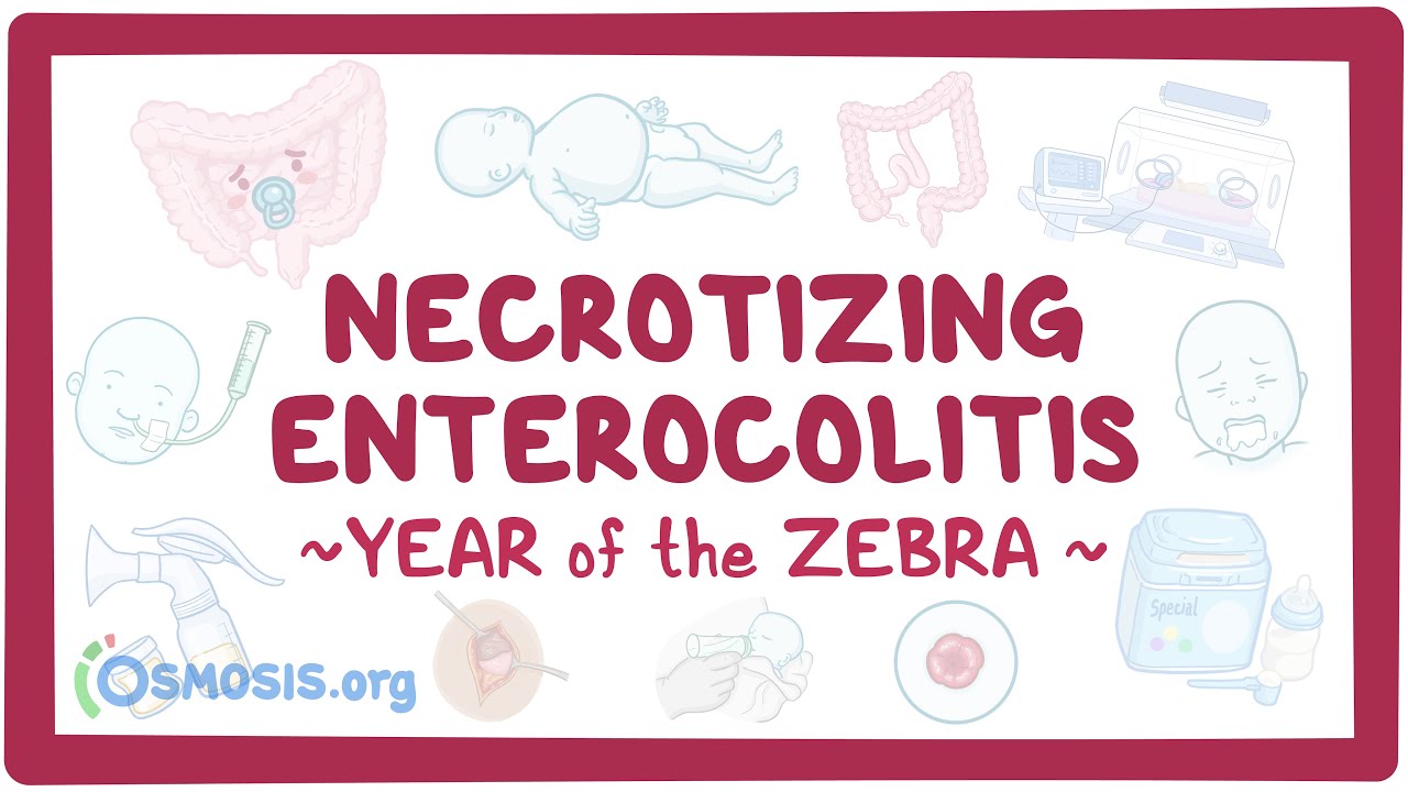 Necrotizing enterocolitis (Year of the Zebra 2024)