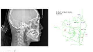 Di xa tuần tự với minivis ngay từ giai đoạn sớm với dây cung nhỏ - nguyên tắc lựa chọn case