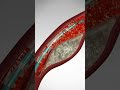 Saving Hearts, One Stent at a Time: Angioplasty & Stent Placement