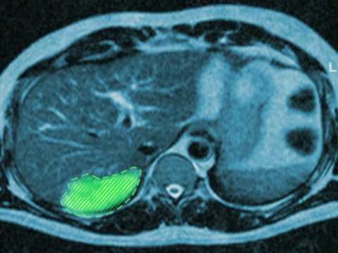 Ureaplazmennogo Behandlung von Prostatitis Welche Medikamente behandeln Prostata