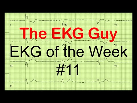 EKG/ECG of the Week #11 | The EKG Guy - www.ekg.md