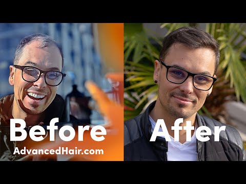 Advanced Hair FUE Transplant | Dustin Lawrence |...