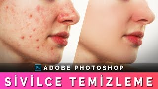PHOTOSHOP SİVİLCE TEMİZLEME | Cilt Temizleme | Photoshop Acne Removal