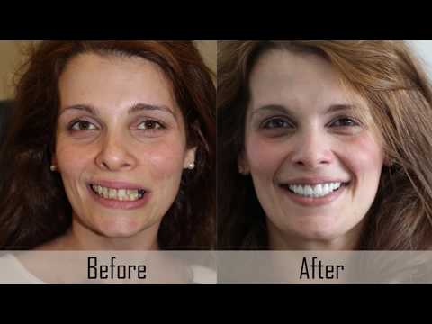 International Patient Review after Cosmetic Smile Design at FMS Dental | Ms. Doha, Australia