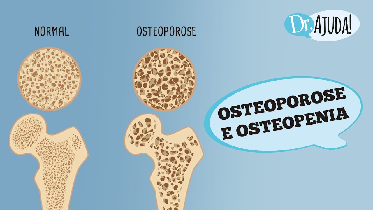 OSTEOPOROSE E OSTEOPENIA: O QUE SÃO? CAUSAS, DIAGNÓSTICOS E TRATAMENTOS