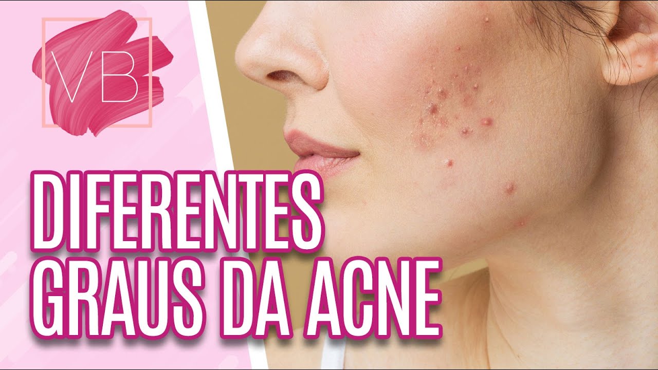 Saiba os graus da acne e porque elas aparecem em diferentes fases da vida - Você Bonita (18/08/2022)