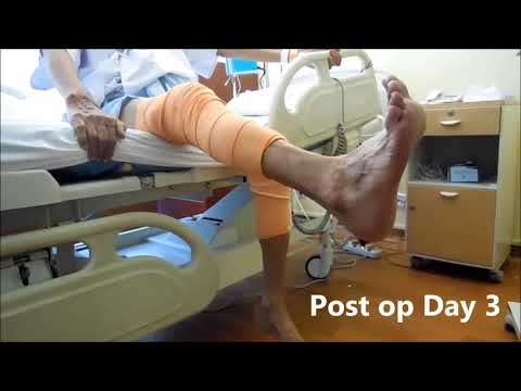 Both Knee Replacement Surgery by Dr. Subhash Jangid through NAV3 Computer Navigation Technique