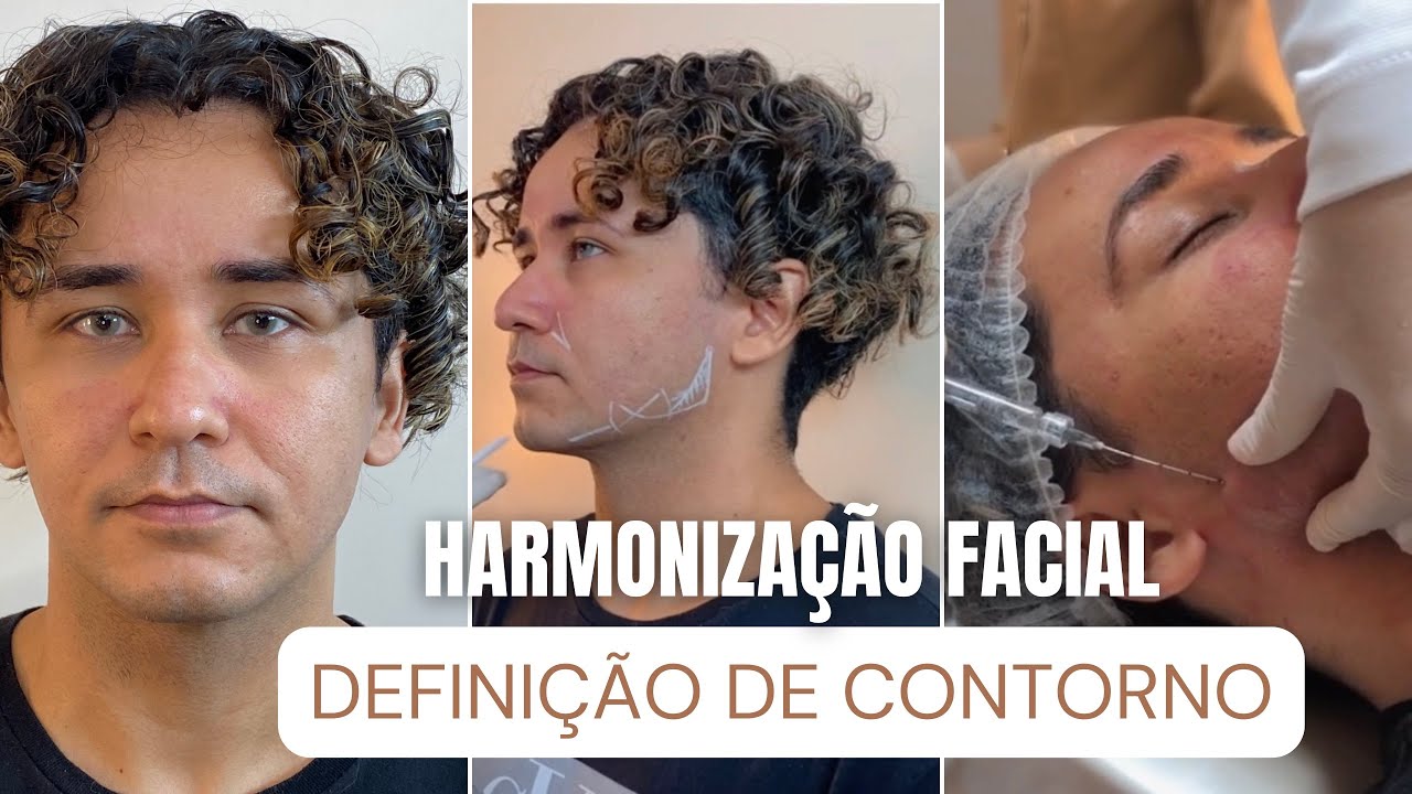 Harmonização Facial Surpreendente: Antes e Depois - Transformação com Ácido Hialurônico e Reação.