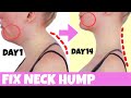 Fix Neck Hump Fat!! Lift Sagging Jowls, Get Slim Long Neck, Look Younger With This Exercises!
