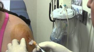 Subacromial Bursitis