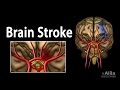 Brain Stroke Types Of Causes Pathology Symptoms Treatment And Prevention Animation