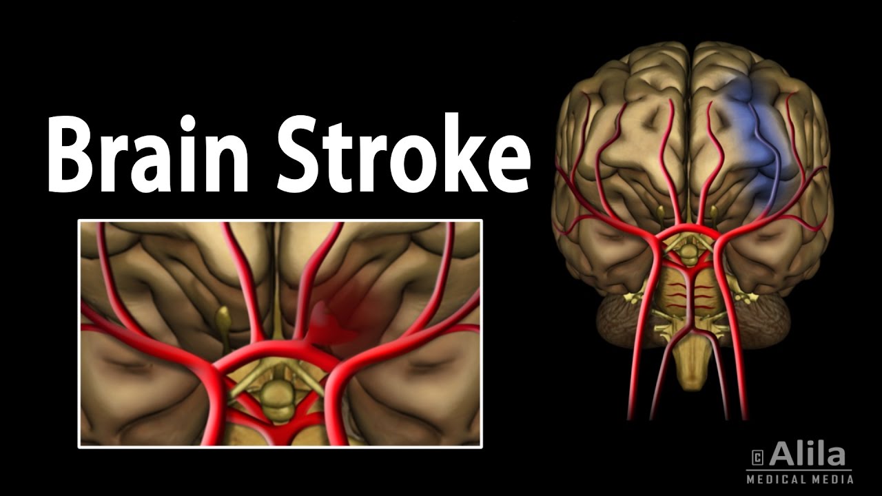 Brain Stroke, Types of, Causes, Pathology, Symptoms, Treatment and Prevention, Animation.