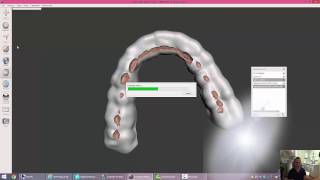 CEREC STL Night Guard