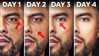 How To Fix Your Skin in 4 Days  (Use At Home Products)