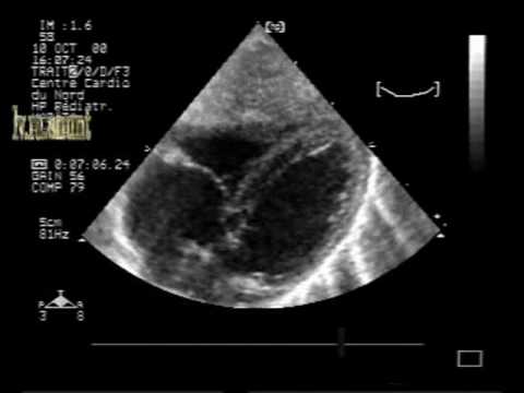 Left Ventricular - Right Atrial Communication (Gerbode type defect)