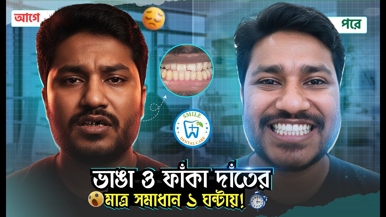 ভাঙ্গা ও ফাঁকা দাঁতের সমাধান মাত্র ১ ঘণ্টায়! - ভিডিও পর্যালোচনা