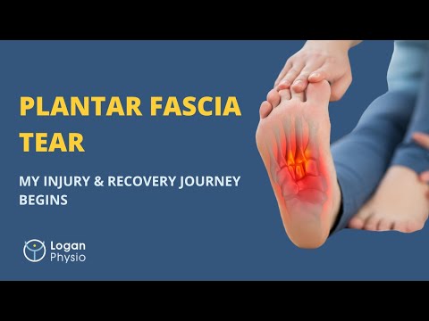 Plantar Fascia Tear: My Injury & Recovery Journey Begins