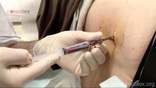 Bone marrow aspiration and biopsy from the iliac crest • Oncolex