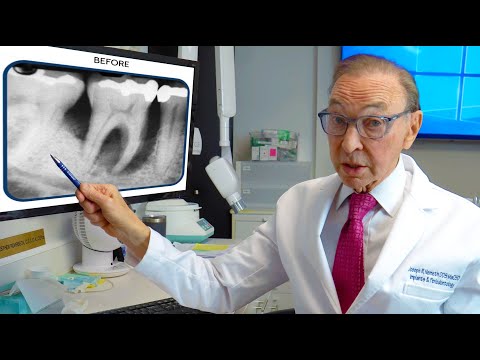Bone Growth Can SAVE Teeth Damaged by Gum Disease! Before & After Photos