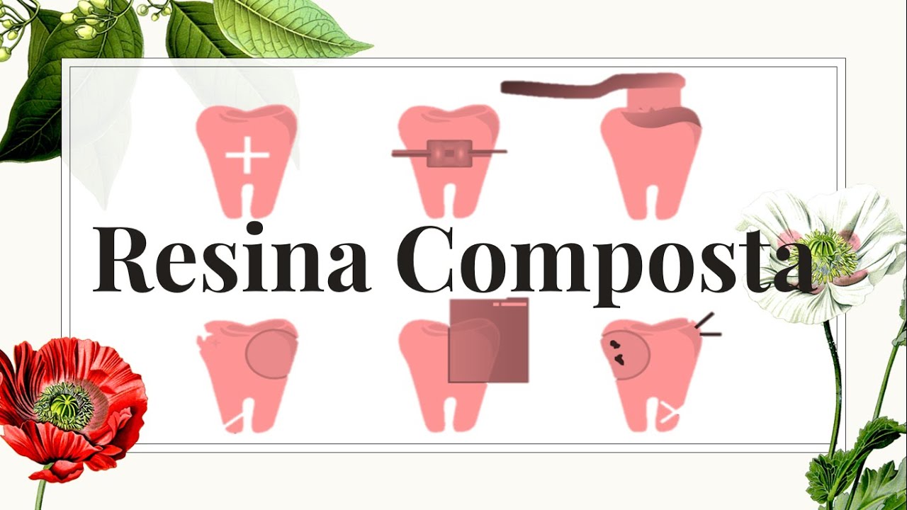 Resina Composta e seu Protocolo Clínico | Materiais Restauradores - Resumos de Odonto