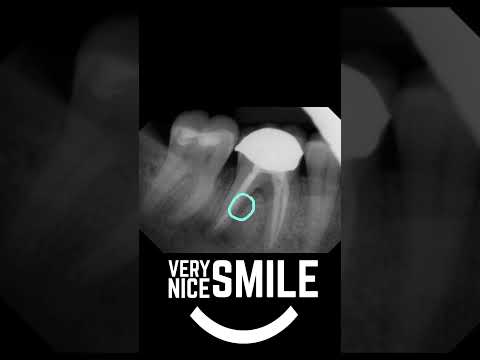 Failing Root canal x-ray