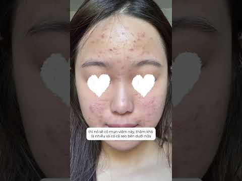 Acne treatment for baby Tram at Zahan Clinic #zahanclinic #drtrangiakhanh