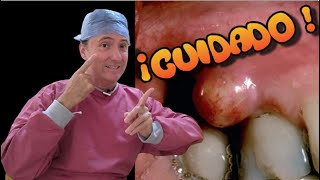 Mucocele vs absceso dental