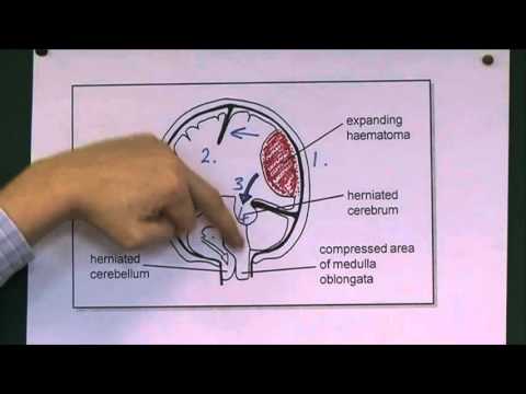 Stretching-Übungen für die Gelenke Akupunktur hilft bei herniated Halswirbelsäule