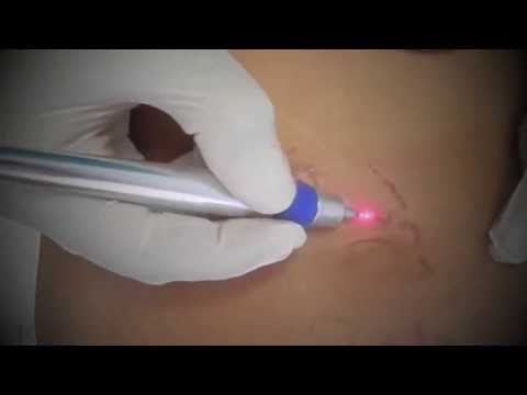 Affronti il pacco la pelle secca di 50 anni Laser biorevitalization delle risposte di persona
