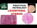 LEIOMYOMA UTERUS Etiology Clinical Features Gross Microscopy