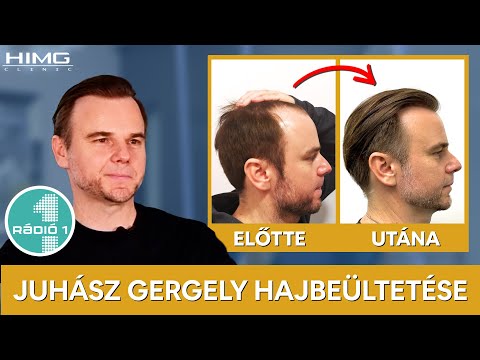 Hajbeültetés előtte-utána: Juhász Gergely - HIMG hajbeültetési klinika
