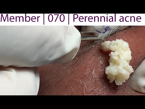 Acne Treatment Huong Da Nang# 070 | Perennial acne