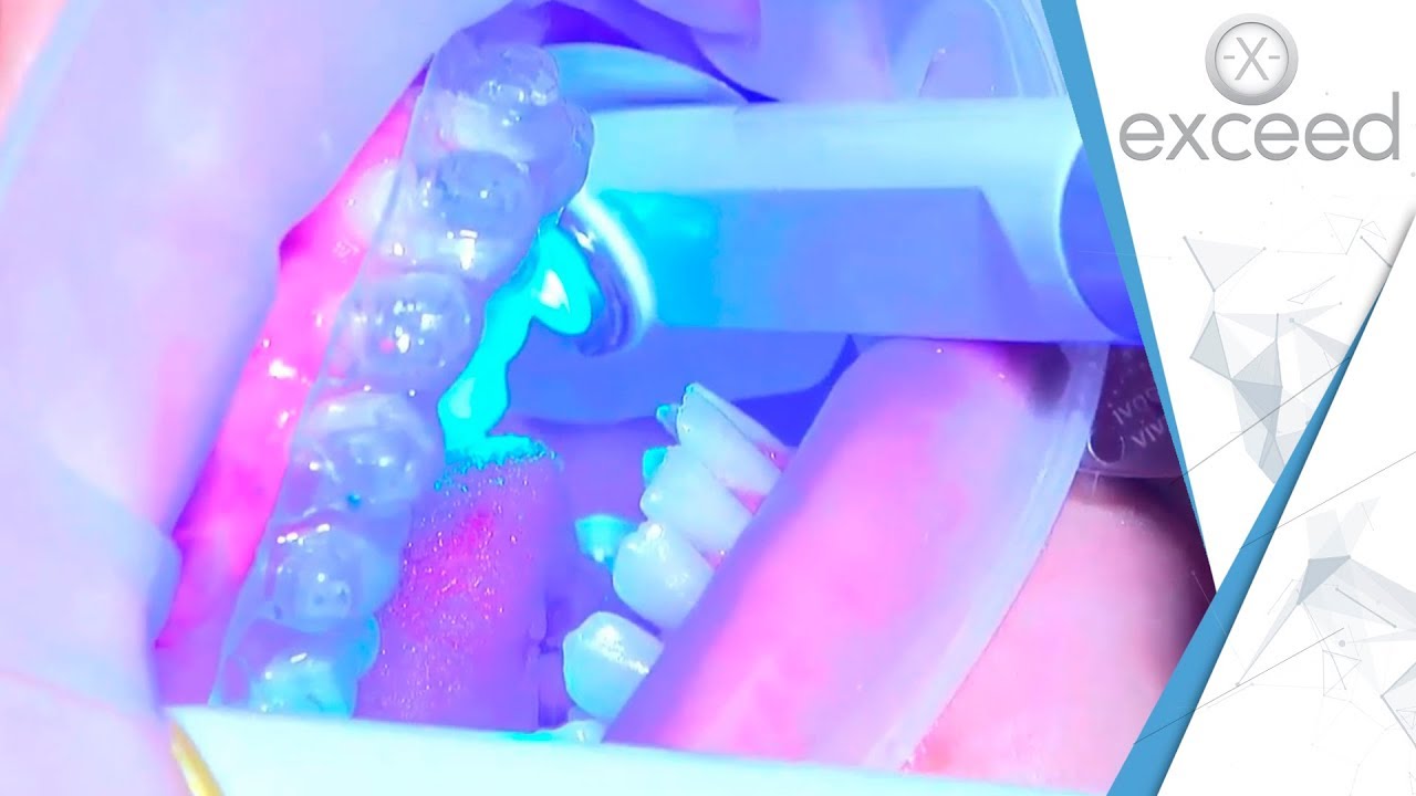 Unit 6 - eXceed IDB Chair-Side Bonding