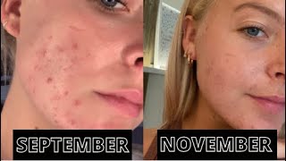 ACNE STORY TIME - TWO MONTH SKIN TRANSFORMATION | how duac saved my skin