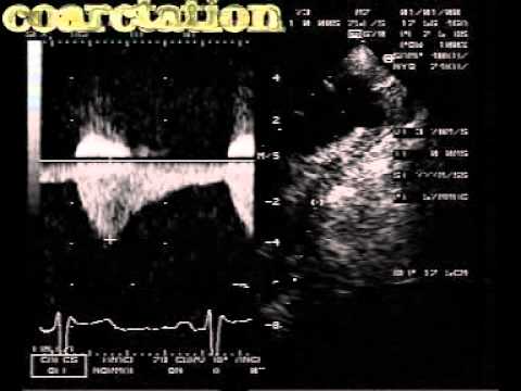 Coarctation Of The Aorta (CoA)