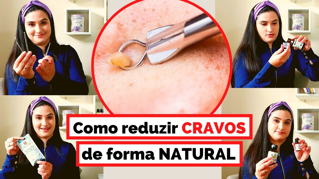 Como reduzir cravos de forma natural!