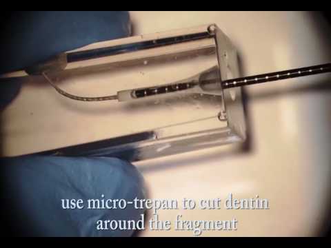 Broken Instrument Removal Kit Verkadent Zumax