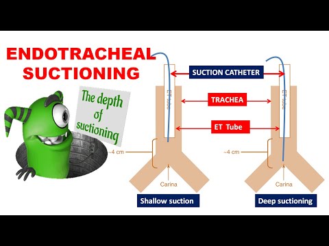 Endotracheal suctioning | Indications | Catheter selection | Pre-oxygenation | Duration of suction
